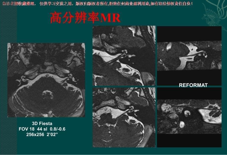 头颈部肿瘤影像诊断与鉴别_第5页