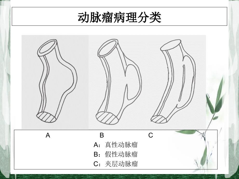 假性动脉瘤的治疗与护理_第4页