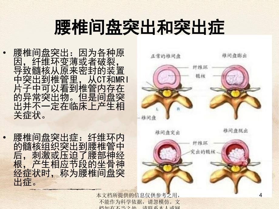 腰椎间盘突出症的康复治疗_第4页