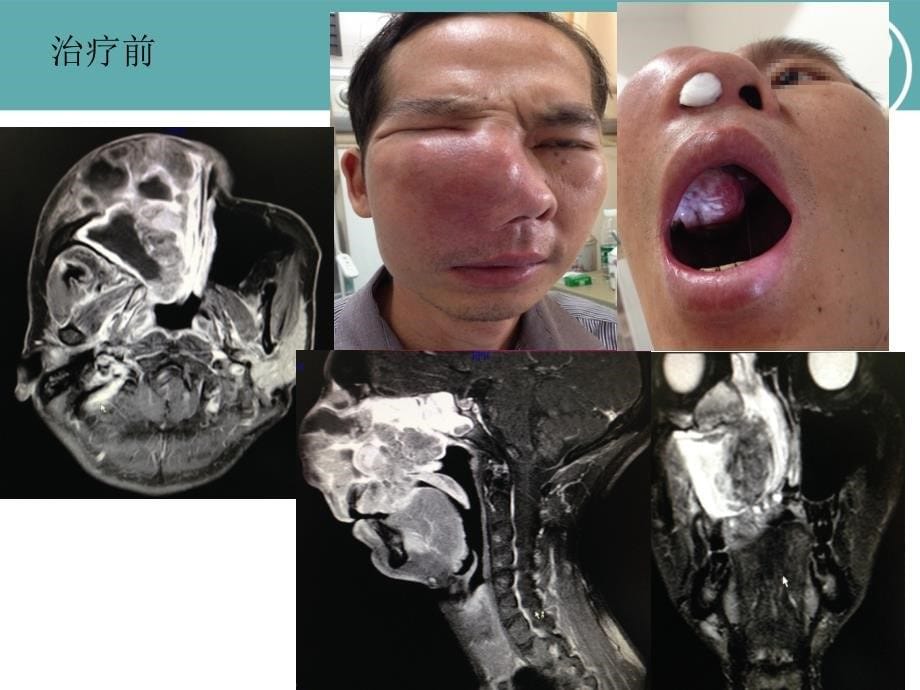 （优质课件）放射性口腔粘膜炎疼痛治疗病例分享_第5页