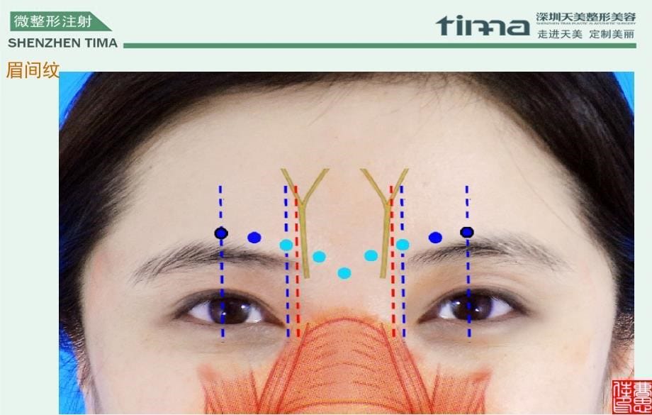 美容培训课件——肉毒素注射方法_第5页