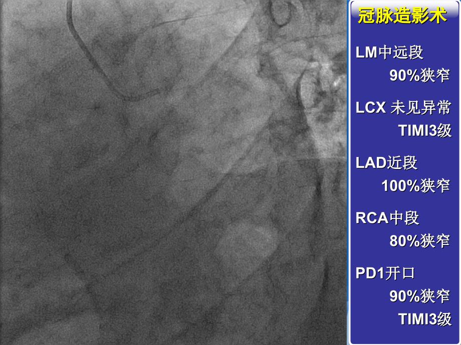 一例左主干病变的介入手术治疗PPT文档_第2页