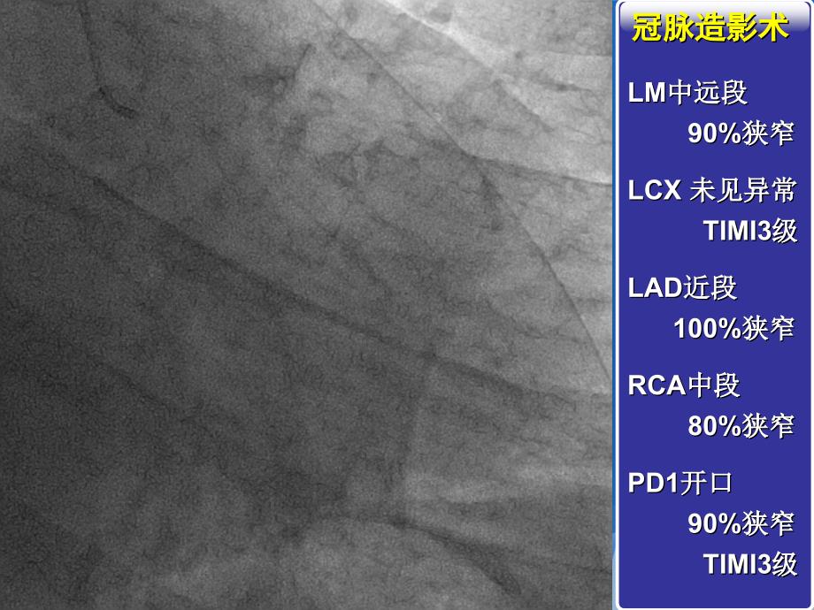 一例左主干病变的介入手术治疗PPT文档_第3页