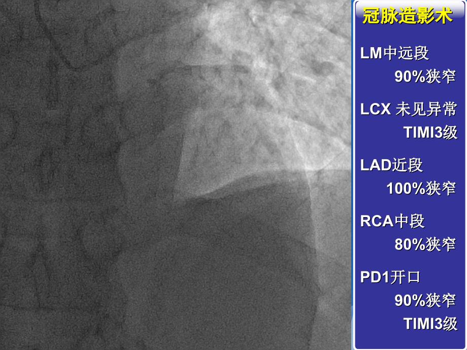 一例左主干病变的介入手术治疗PPT文档_第4页