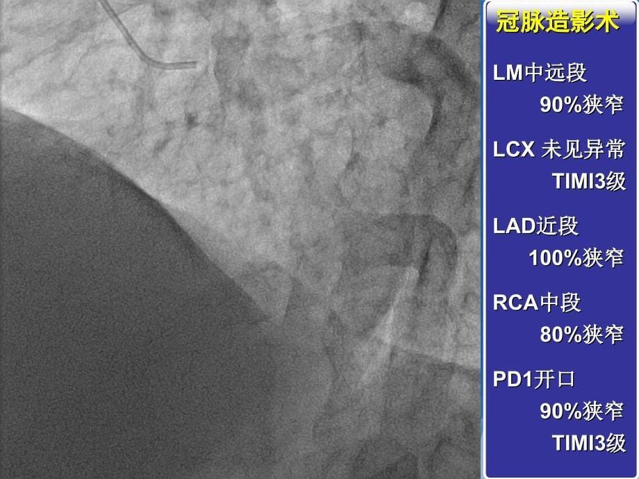 一例左主干病变的介入手术治疗PPT文档_第5页