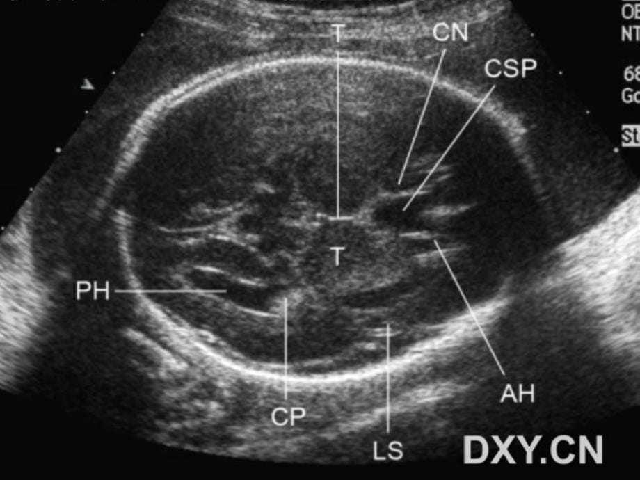 胎儿超声标准切面课件_第5页