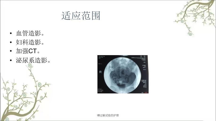 碘过敏试验的护理课件_第5页