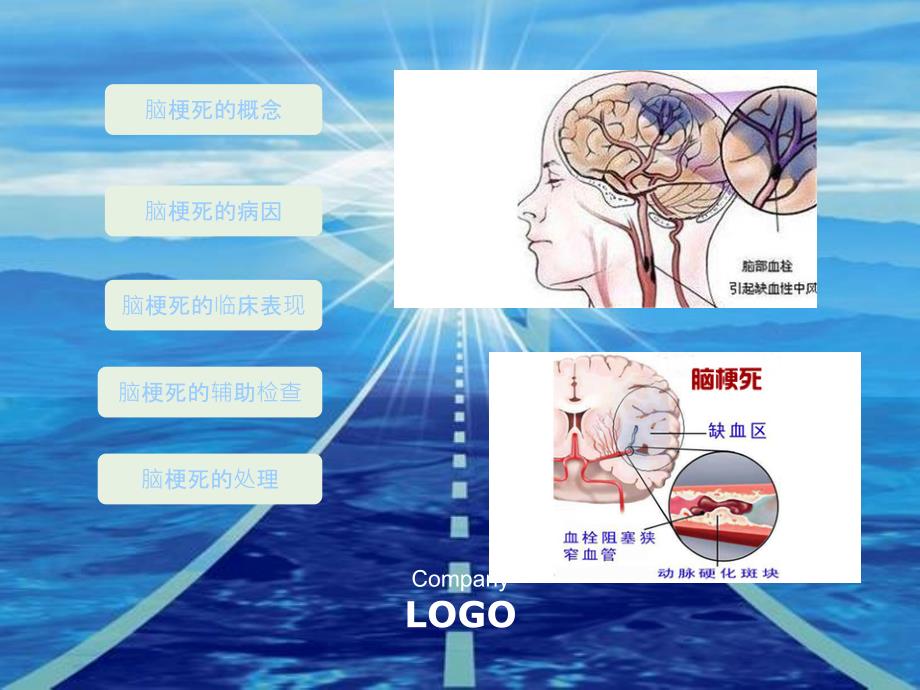 脑梗死的处理流程ppt_第3页