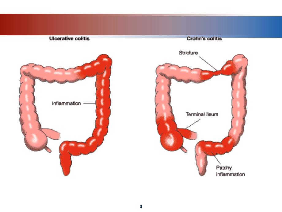 炎症性肠病的药物治疗【资料参考】_第3页