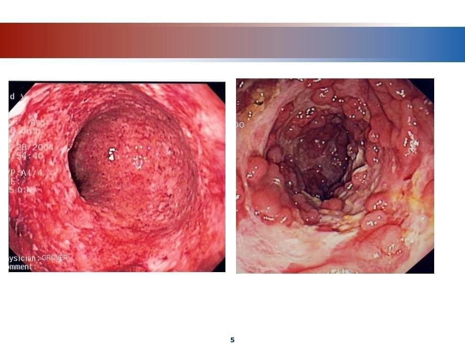 炎症性肠病的药物治疗【资料参考】_第5页