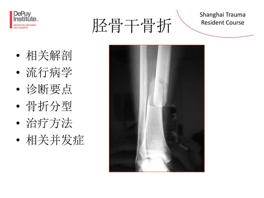 胫骨干骨折包括骨筋膜室综合征ppt课件_第3页