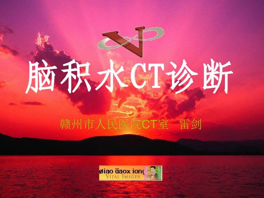 脑积水CT诊断.ppt_第1页