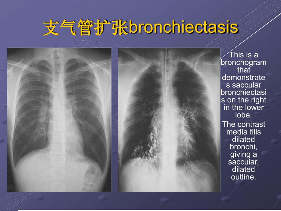 支气管扩张症及咯血护理讲解课件_第3页