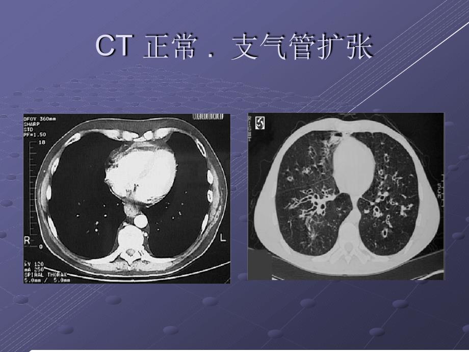 支气管扩张症及咯血护理讲解课件_第4页