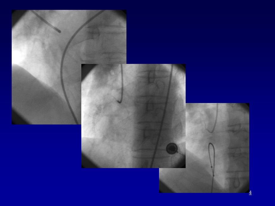 冠心病教学要PPT_第4页