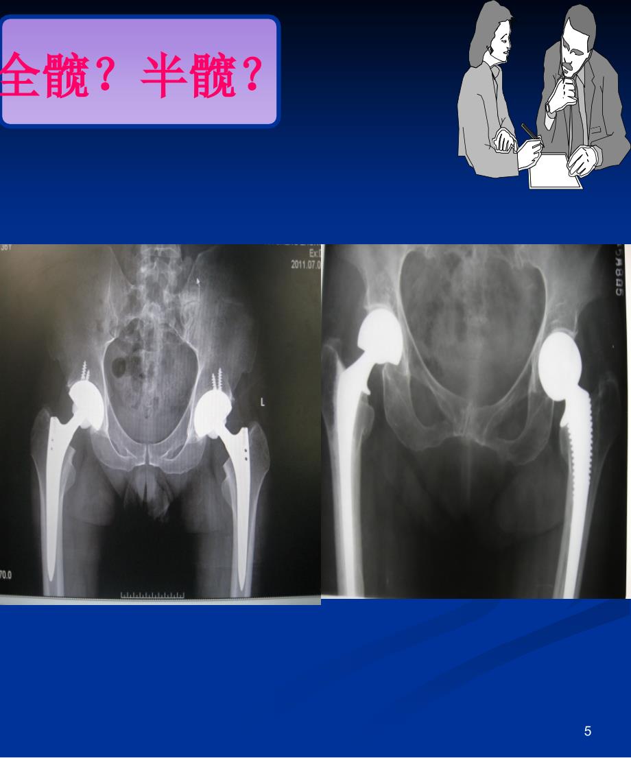 髋关节假体的选择 ppt课件_第2页