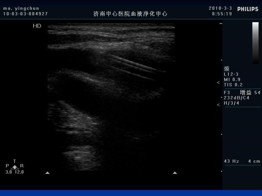 深静脉置管的相关知识.ppt_第5页