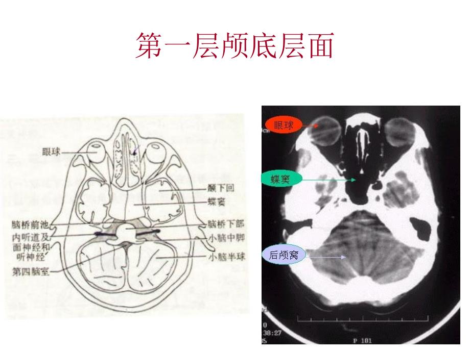 颅脑基本病变的CT诊断_第1页