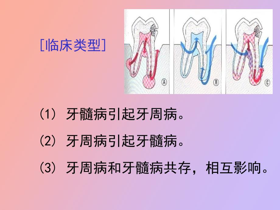 牙周炎伴发病变牙周病治疗_第3页