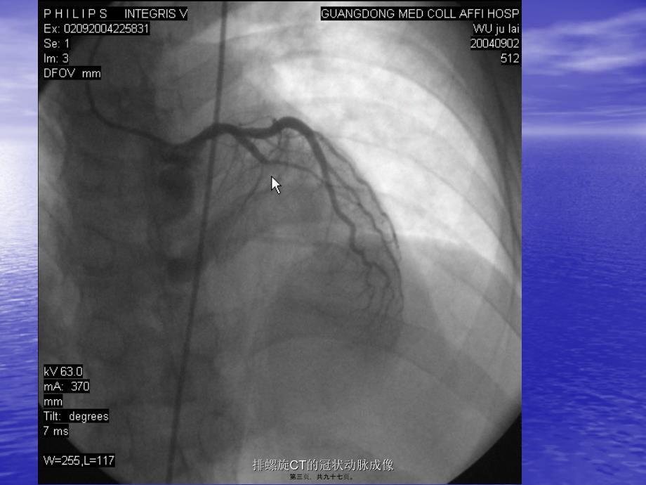 排螺旋CT的冠状动脉成像课件_第3页