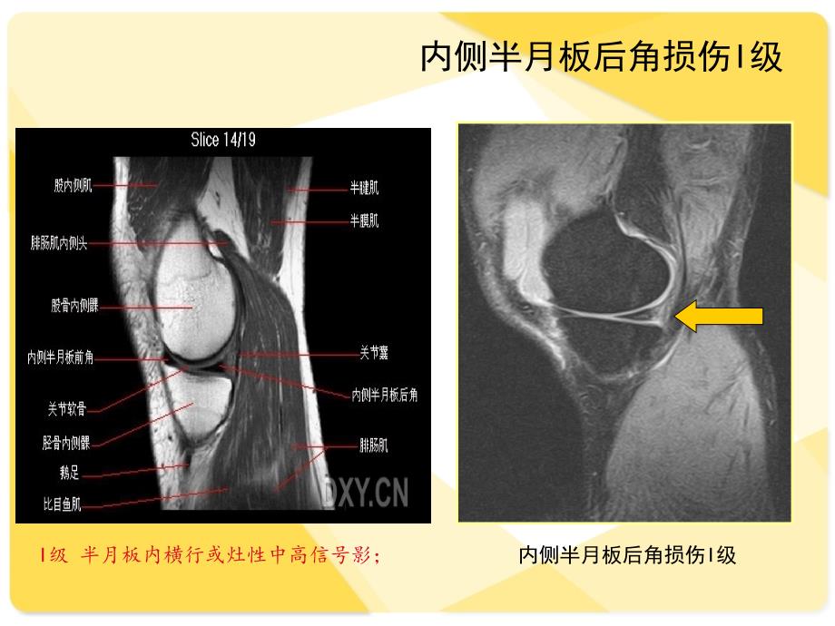 膝关节韧带MRI损伤表现_第2页