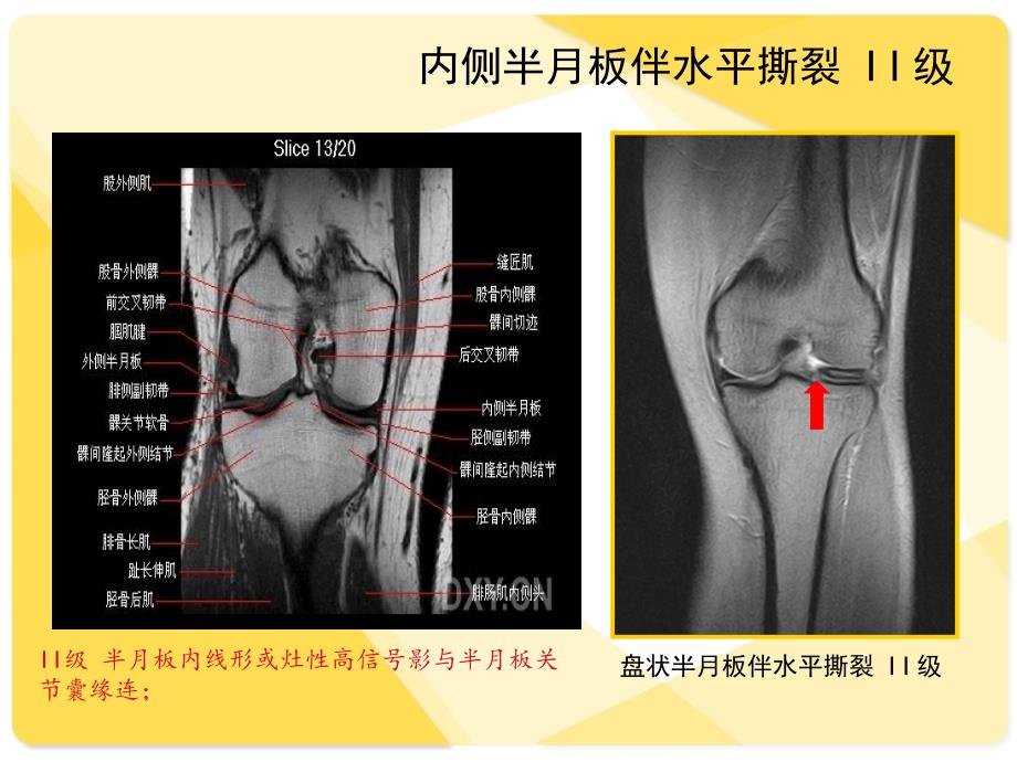 膝关节韧带MRI损伤表现_第3页