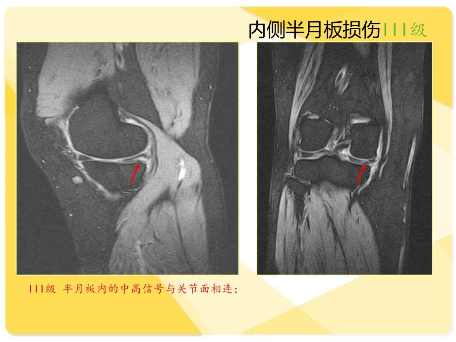 膝关节韧带MRI损伤表现_第4页
