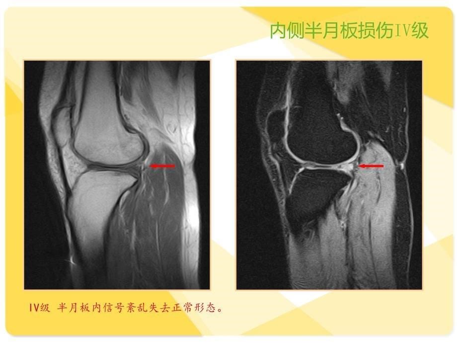 膝关节韧带MRI损伤表现_第5页