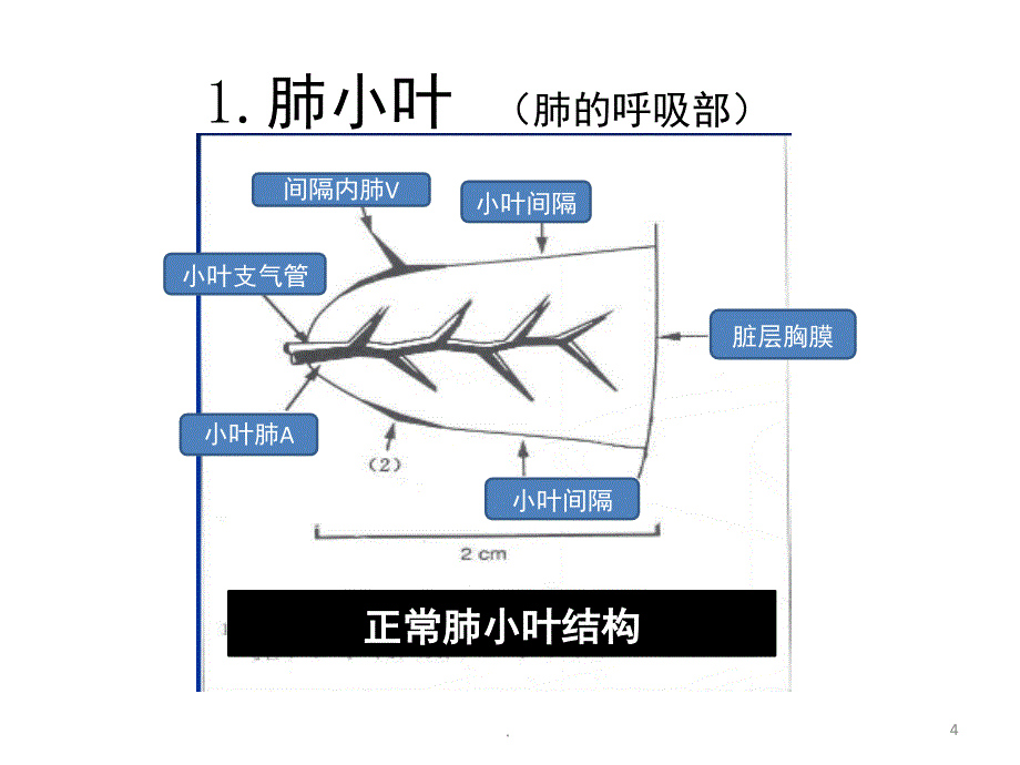 肺小叶HRCT表现课堂PPT_第4页