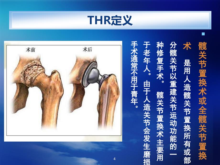 人工髋关节置换术(ppt).ppt_第4页