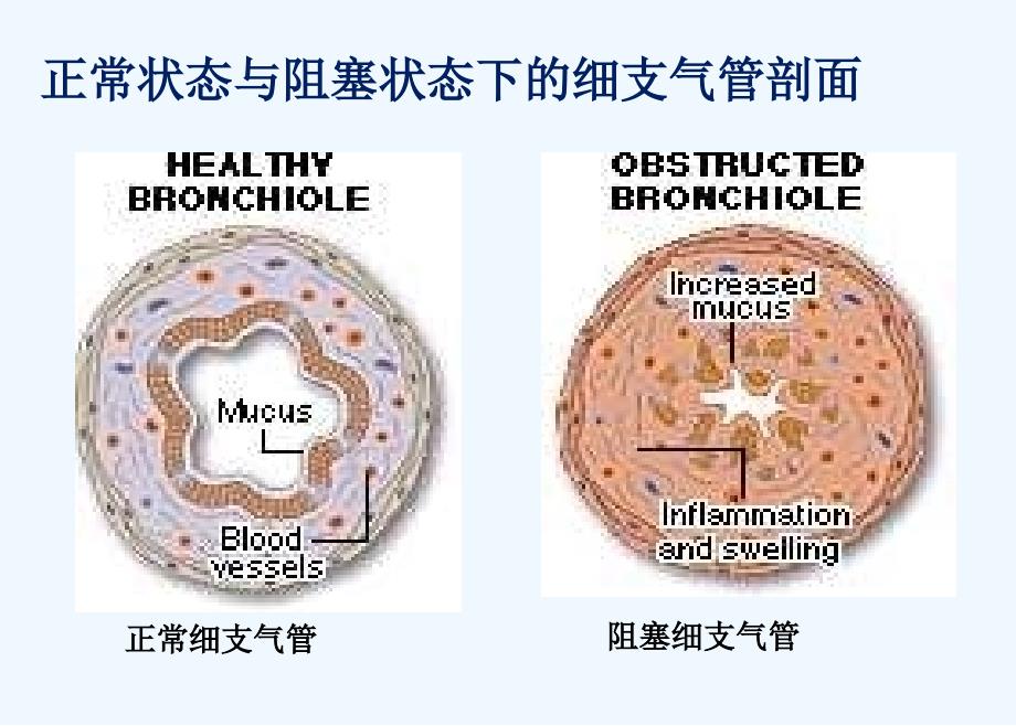 哮喘健康教育--支气管哮喘防治课件_第4页