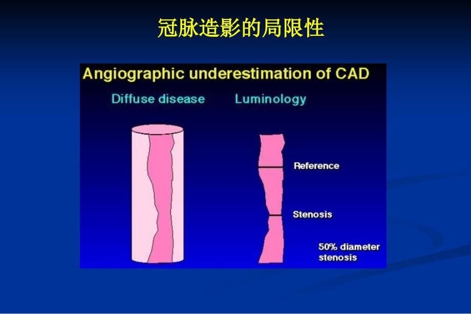 冠脉造影金准面临的挑战_第5页