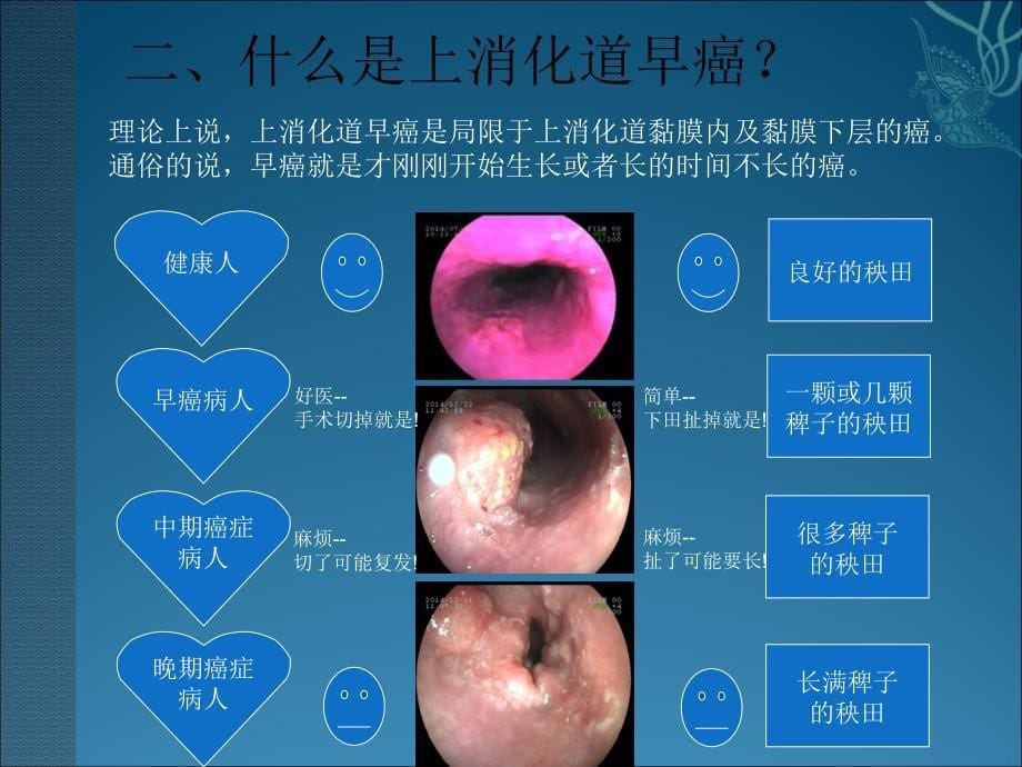 上消化道早癌筛查.ppt_第5页