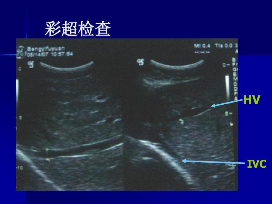 肝静脉型布加综合征的介入治疗及中远期疗效观察_第5页