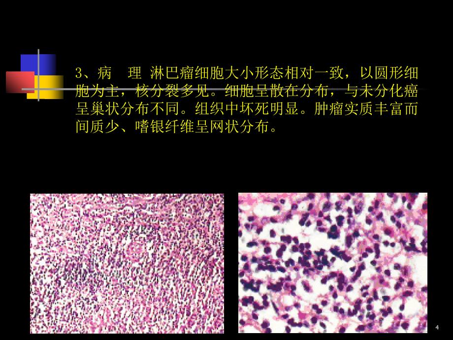 优质医学鼻咽部肿瘤的CT诊断和鉴别_第4页