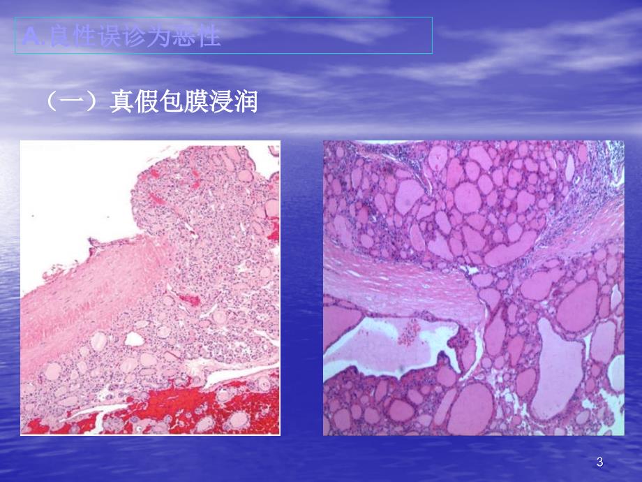 甲状腺诊断中的陷阱和免疫组化ppt课件_第3页