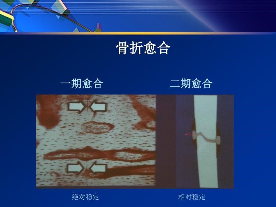 骨科内固定经典理论_第5页