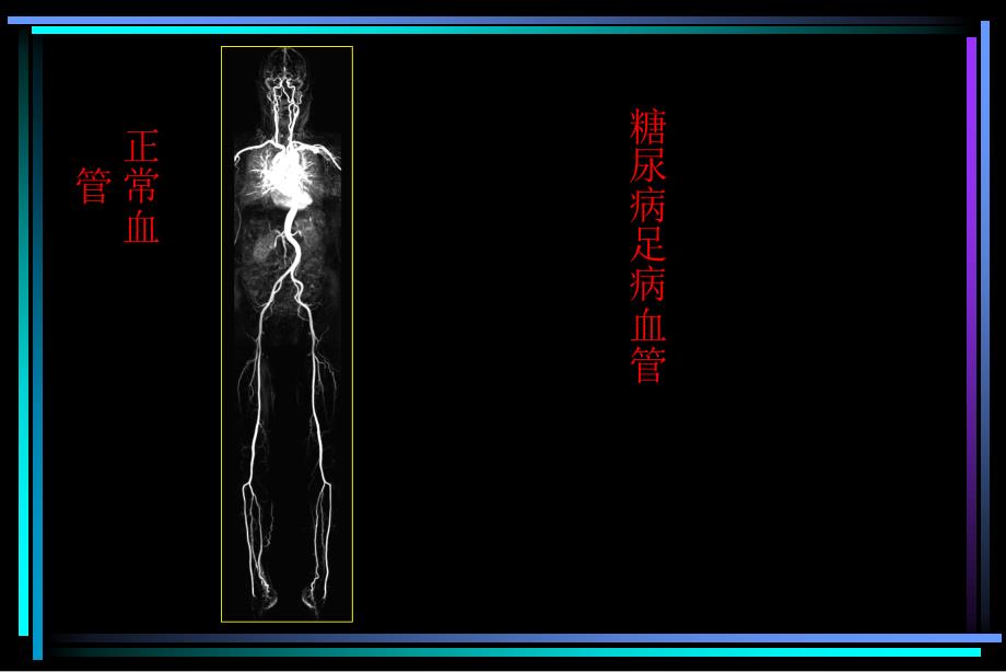 CEMRA对糖尿病足血管病变的诊断价值_第2页