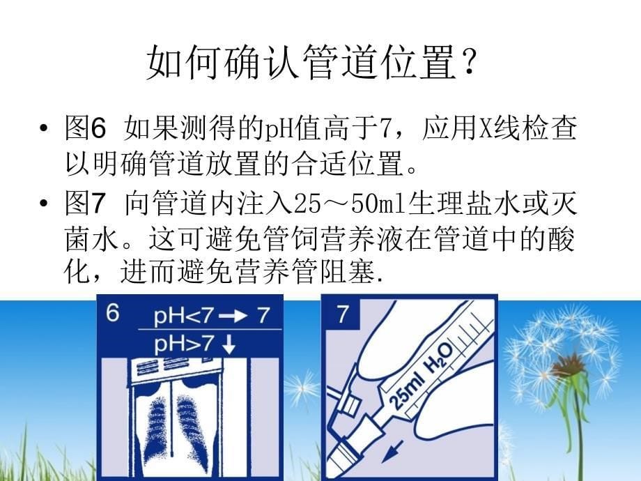 空肠营养管的护理_第5页