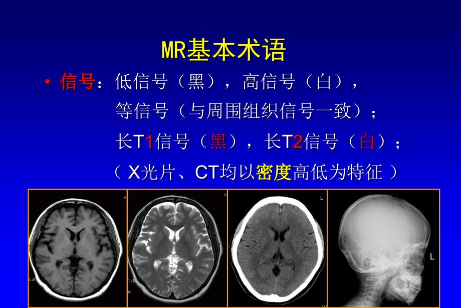 幼儿正常颅脑MRI表现.ppt_第4页