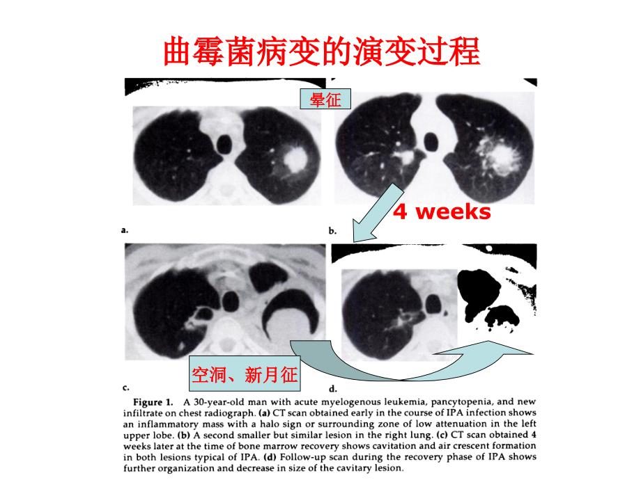 医院肺真菌病的影像诊断4_第4页