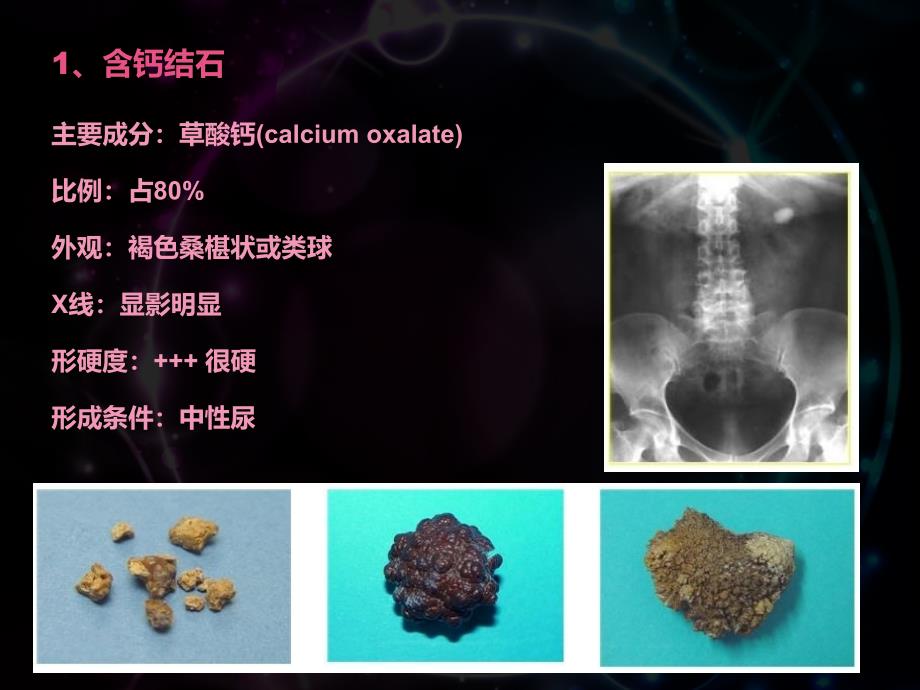 肾结石的诊断_第4页