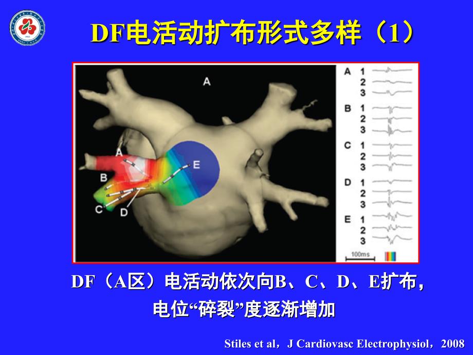 导管消融治疗房颤进展_第4页