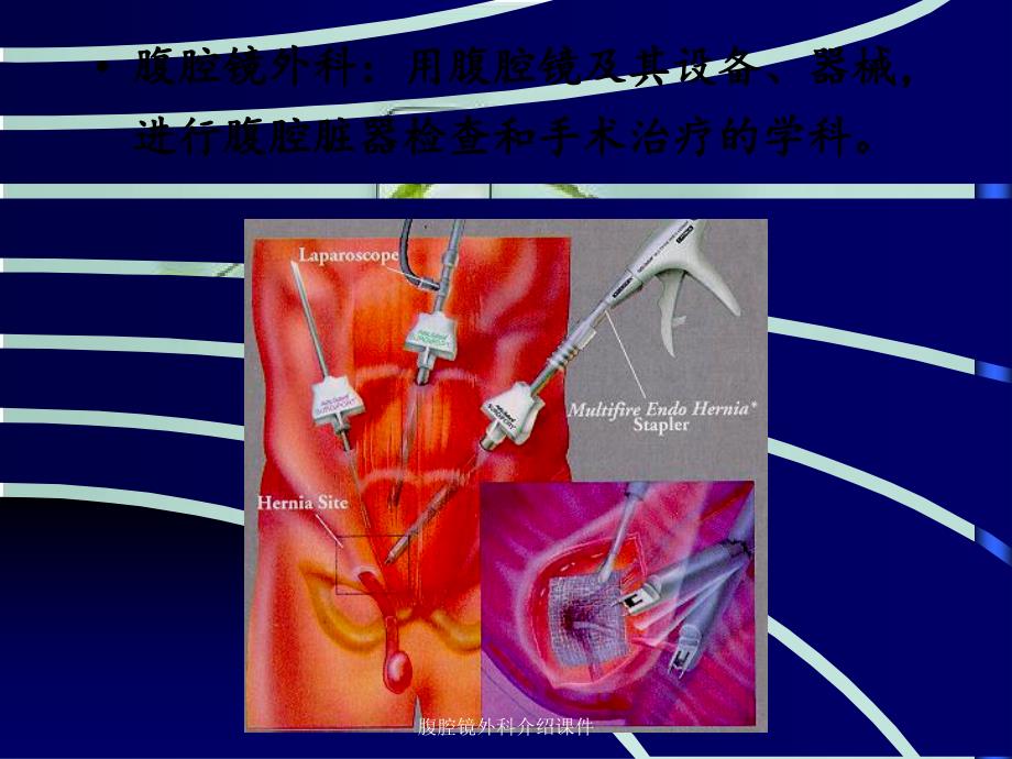 腹腔镜外科介绍课件_第4页