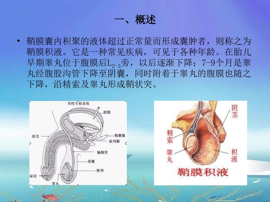 鞘膜积液业务学习学习总结总结汇报实用文档_第2页