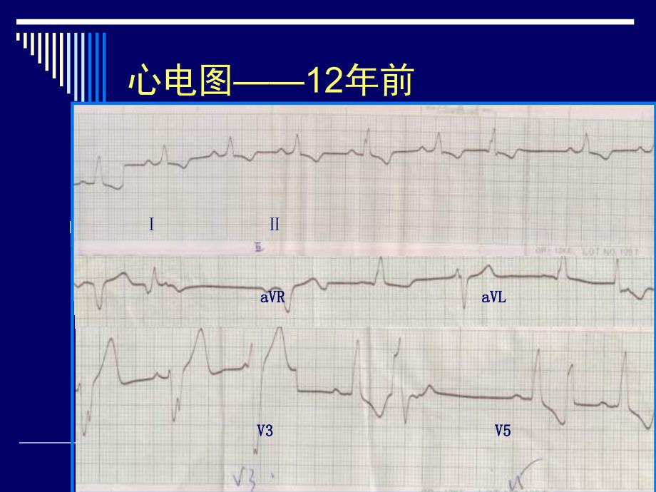 肥厚型心肌病患者递进式介入治疗与长期随访_第4页