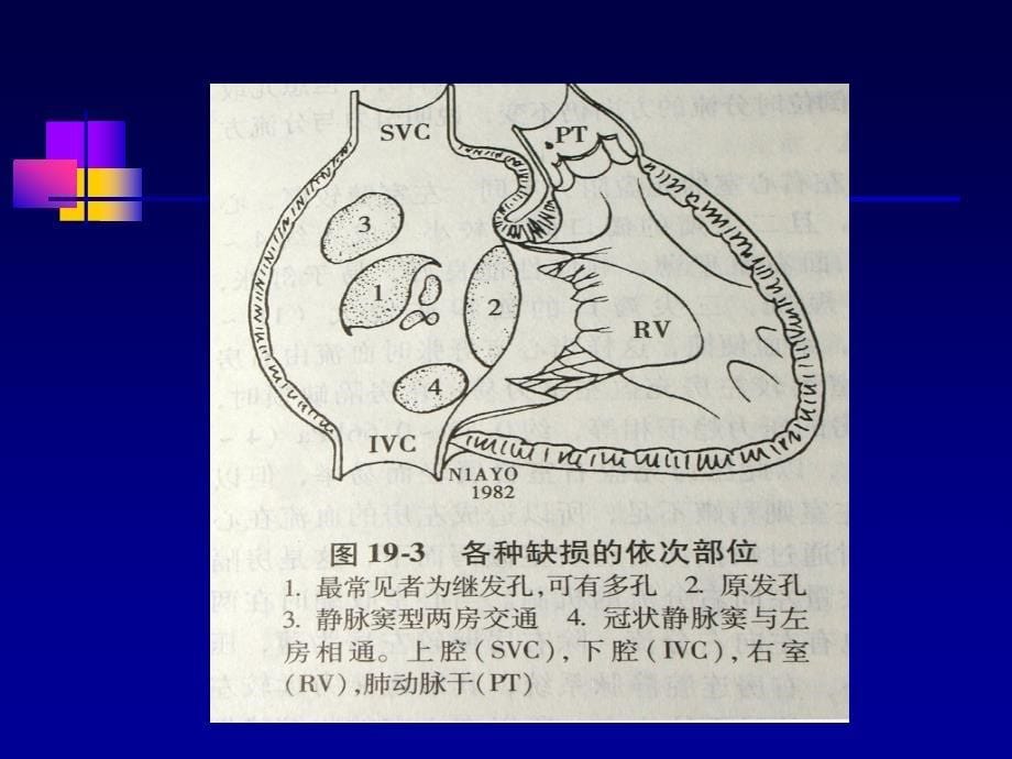 儿科学循环系统房间隔缺损PPT课件【精心整编吐血推荐】_第5页