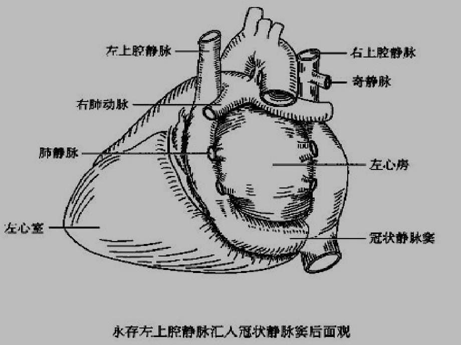 冠状静脉窦无顶综合征ppt课件_第5页