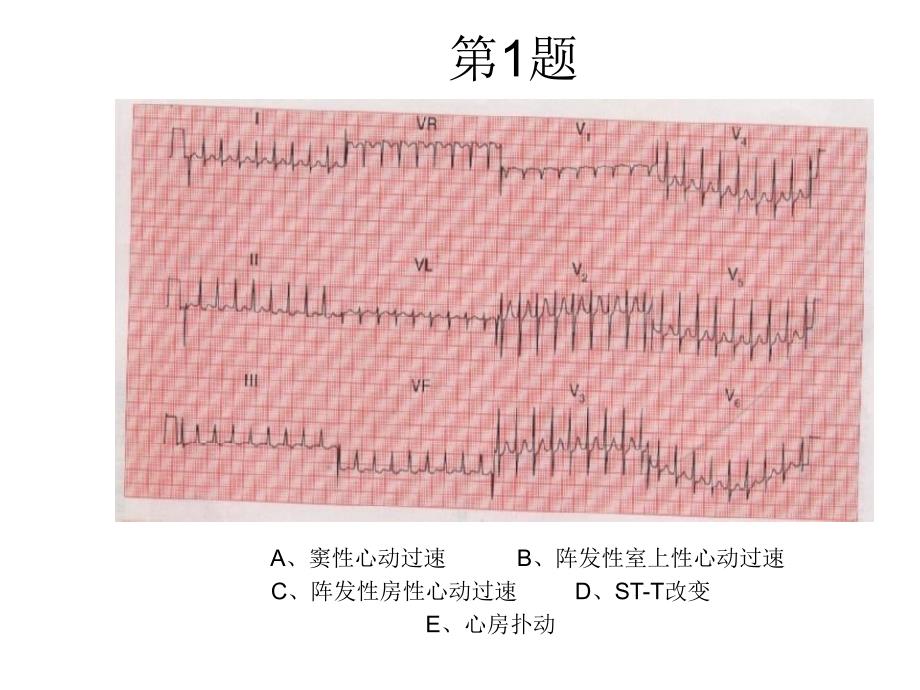 心电图考核题ppt课件_第1页