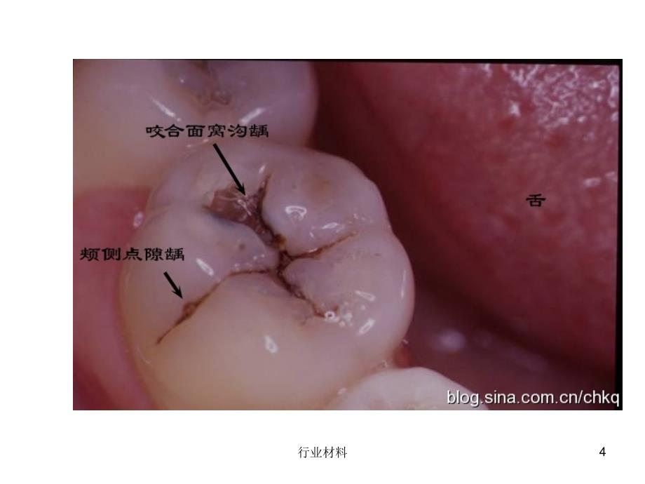 窝沟龋牙本质龋行业特选_第4页